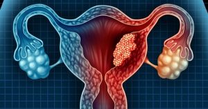 Câncer Endometrial