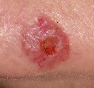 Carcinoma basocelular